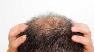 What Are Your Hair Loss Causes & How Acupuncture Help In This?