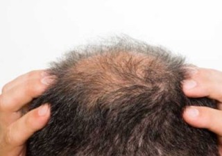 What Are Your Hair Loss Causes & How Acupuncture Help In This?
