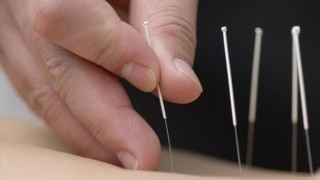 Acupuncture: Myth or Science?
