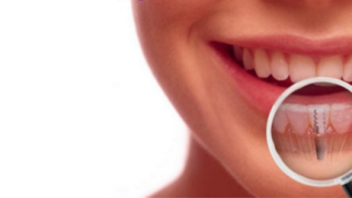 Remove The Misconceptions Surrounding Dental Implants