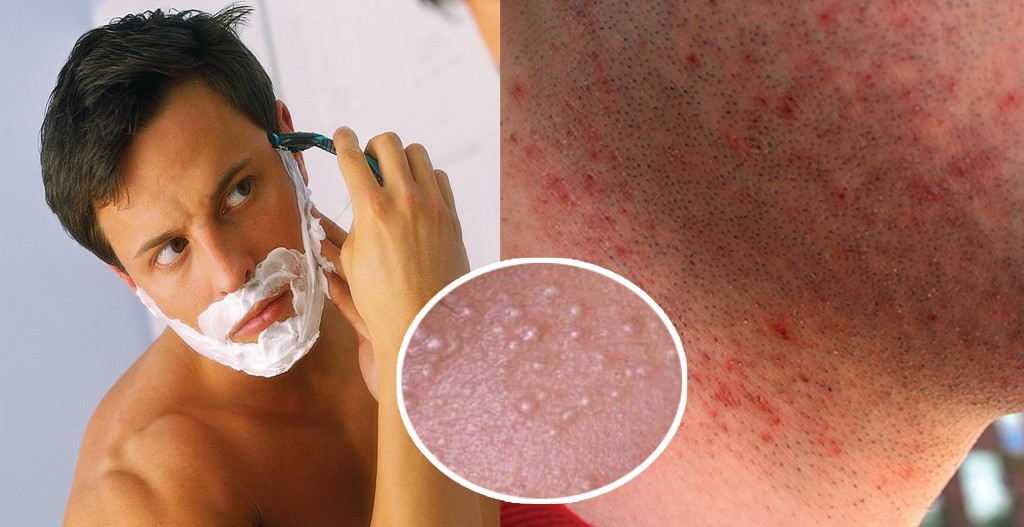 best electric ELECTRIC SHAVERS: SHAVING TIPS FOR MEN WITH ACNEshaver for men with acne