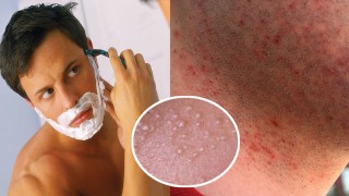 best electric ELECTRIC SHAVERS: SHAVING TIPS FOR MEN WITH ACNEshaver for men with acne