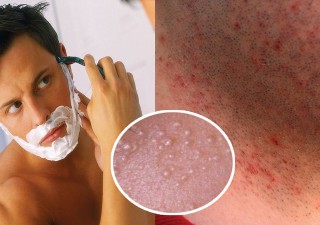 best electric ELECTRIC SHAVERS: SHAVING TIPS FOR MEN WITH ACNEshaver for men with acne