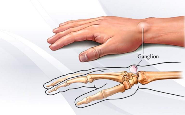 Ganglion Cyst Facts What Doctors Dont Tell You