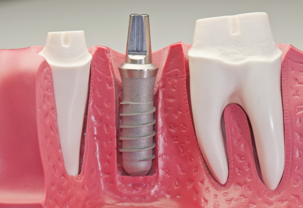 Dental Implant Surgery- Risks and Advantages That Are Attached To It