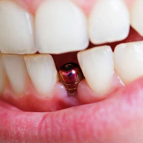 Dental Implants - An Efficient Alternative For Teeth Replacement
