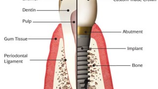 What Are The Benefits Of Getting Tooth Crown Replacement?