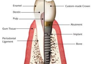 What Are The Benefits Of Getting Tooth Crown Replacement?