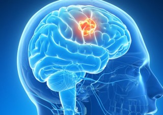 Best Brain Tumor surgeon in India