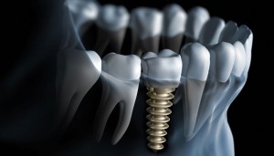 The Various Benefits Of Dental Implants