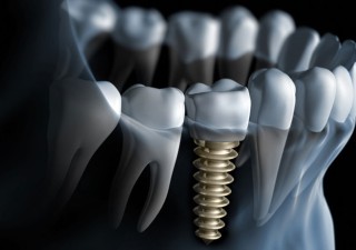The Various Benefits Of Dental Implants