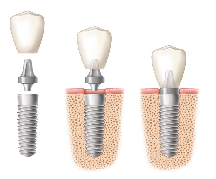 The Various Benefits Of Dental Implants