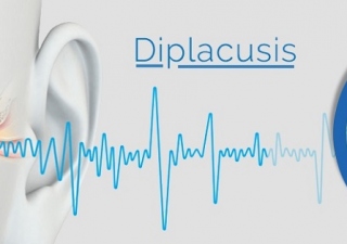 diplacusis